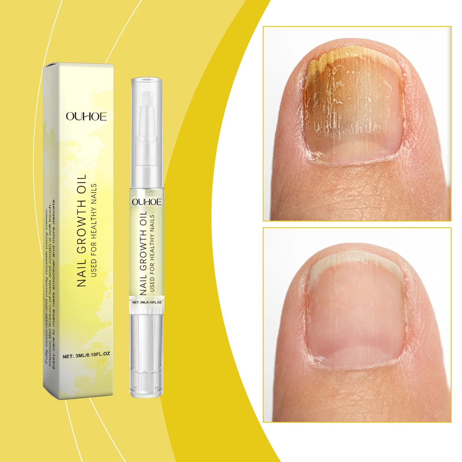 Nagelverzorgingsolie Dagelijkse zachte ingegroeide nagels Reinigende en hydraterende reparatieoplossing