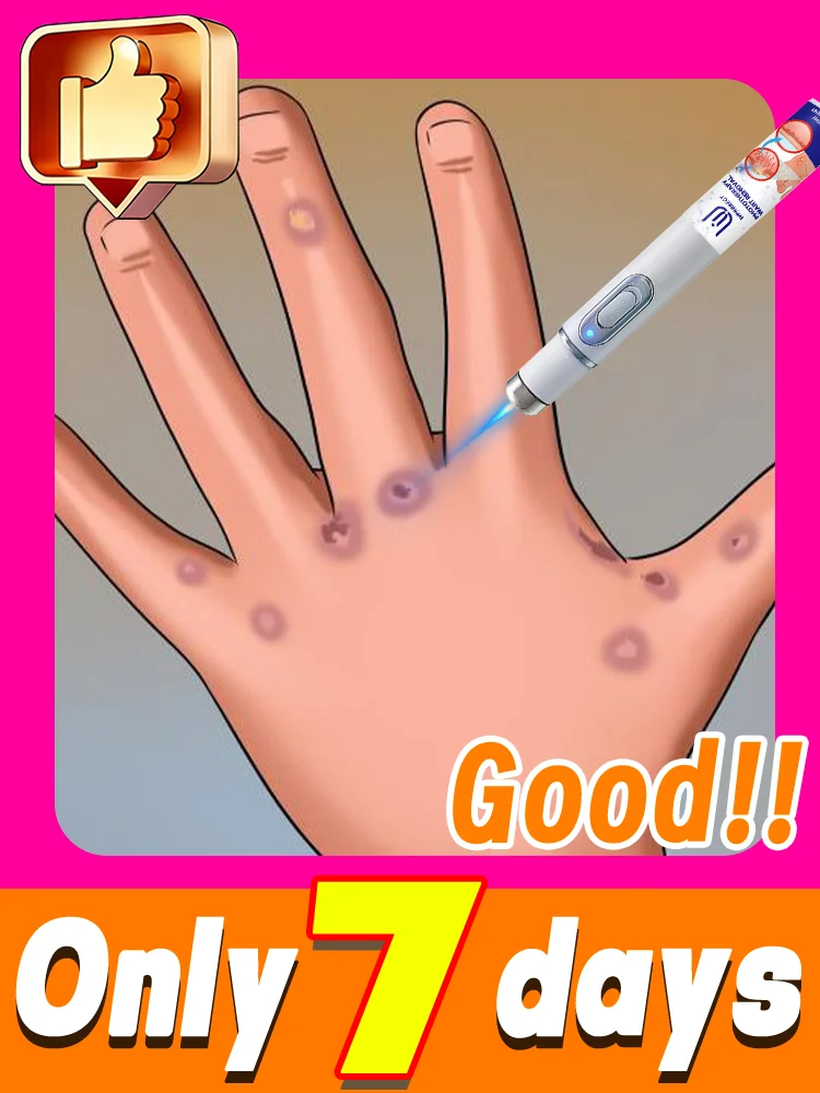 

Skin Care Blue Light Wart Tool Effective to Use Lᴀsᴇʀ Wᴀʀᴛs Rᴇᴍᴏᴠᴀʟ