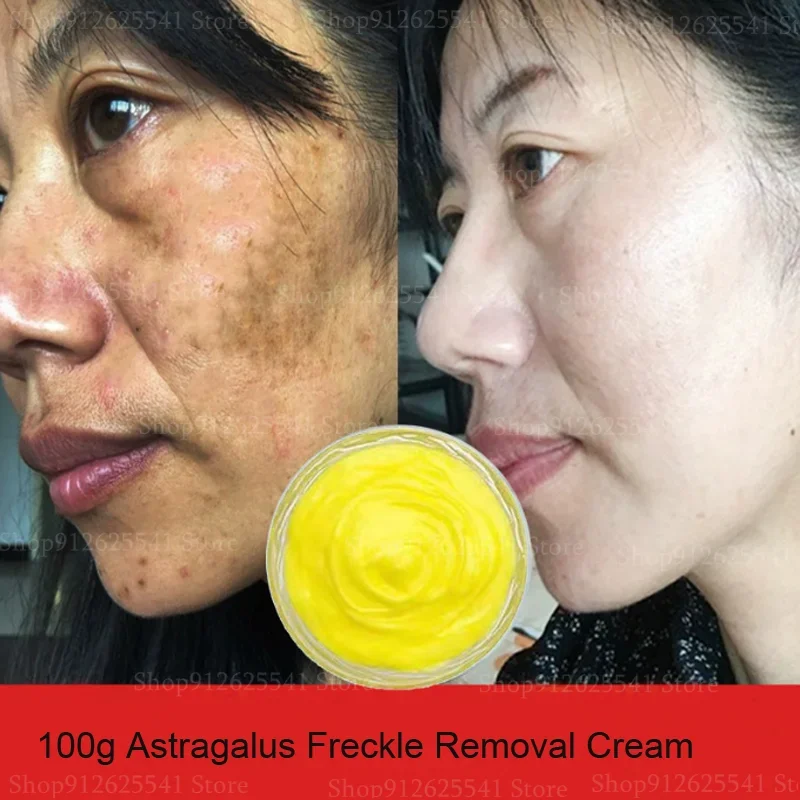 

Quick Spot Remover Freckle Removal Cream Herbal Astragalus Face Cream Moisturizing Whitening Night Cream Facial Treatment Gel