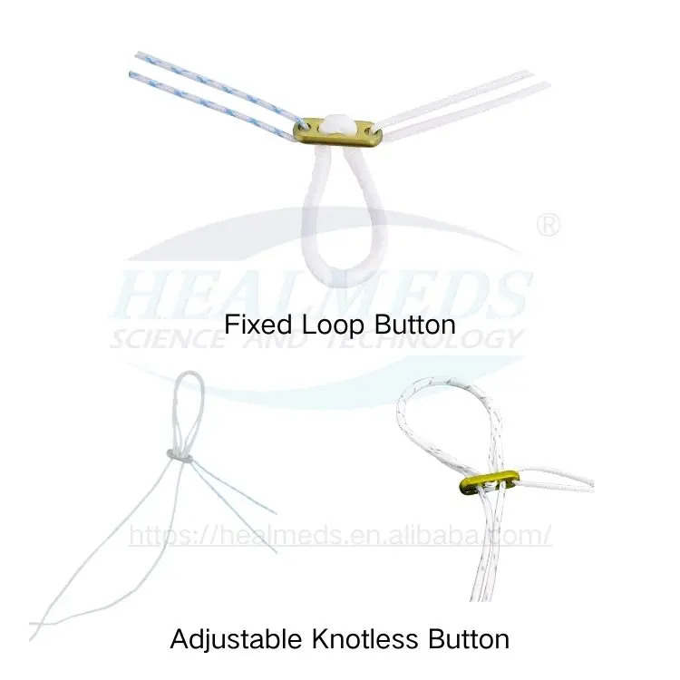 Uhmwpe Adjustable Fixation Sutures Titanium Plate All Inside Knee Imp*-lant Acl Endo Button Adjustable Endobutton for Knee