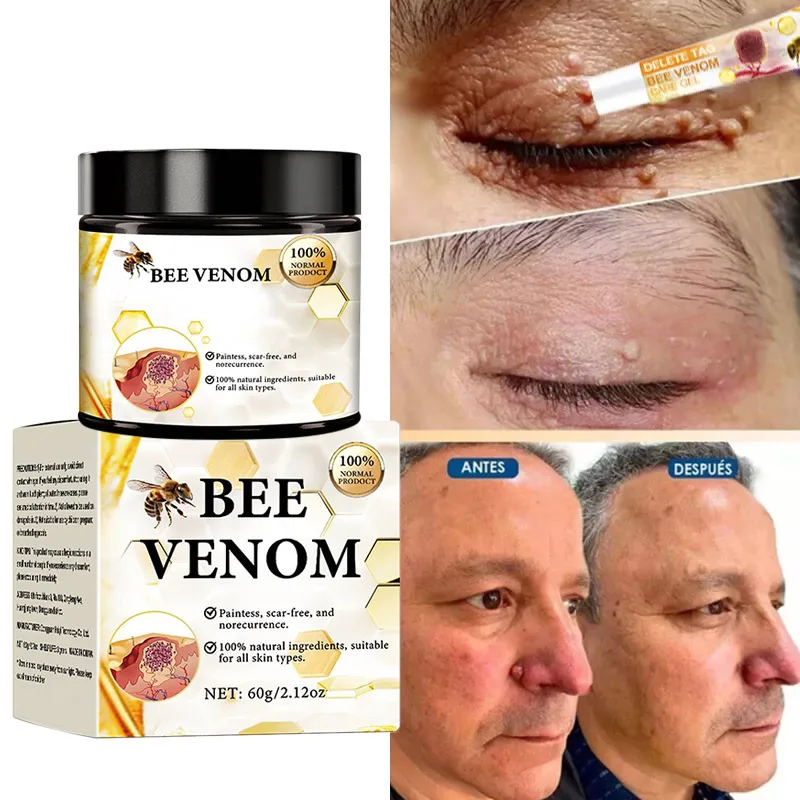 Crema eliminadora de verrugas con veneno de abeja, 60g, con ácido salicílico, cuerpo, mano, pie, piel, eliminación de picazón, reparación de cuidado hidratante suave