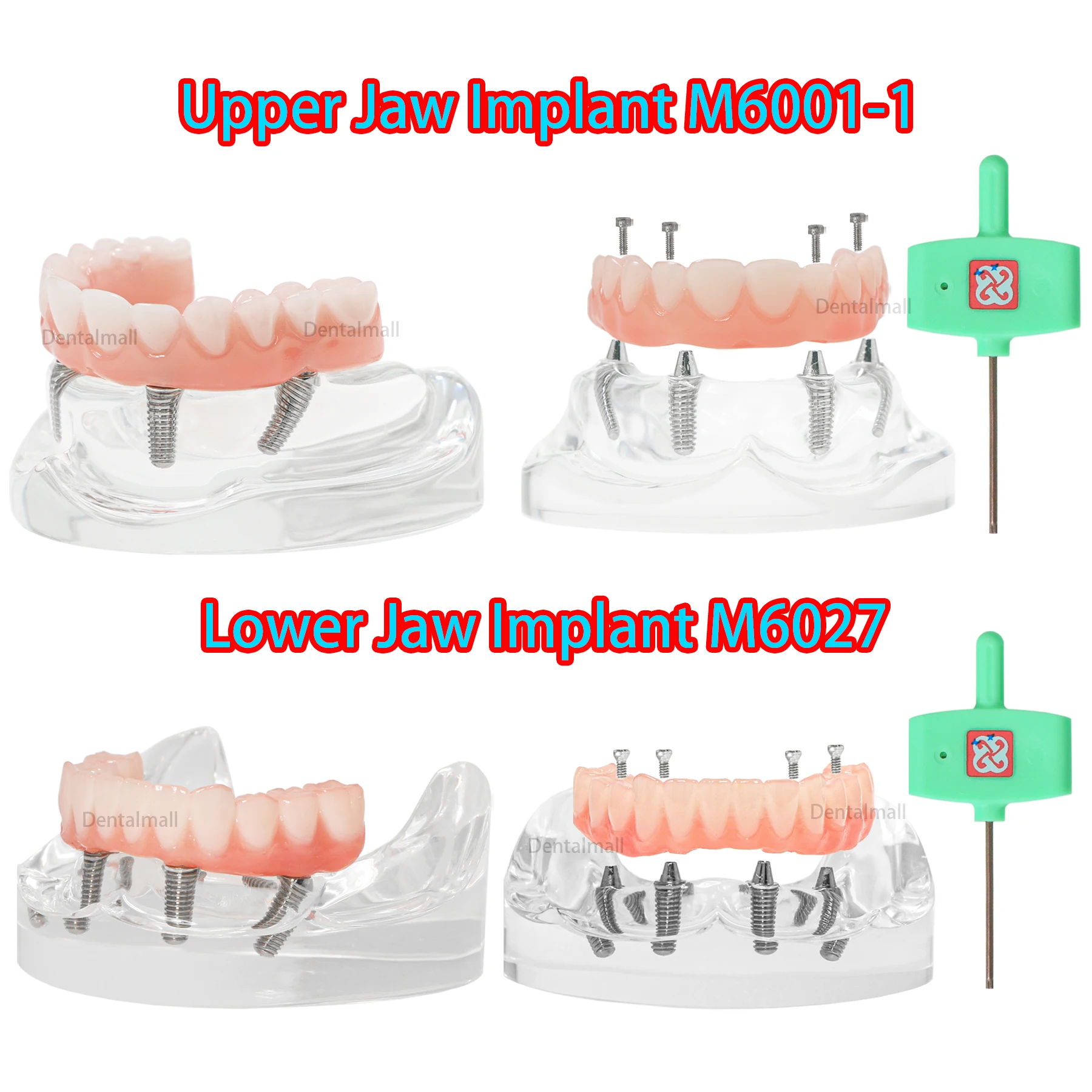 

Dental Overdenture Implant Restoration Model Upper/Lower Jaw 4 Removable Screws Transparent