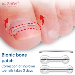 1Pc Foot Ingrown Toenail Correction Tool Ingrown Toe Nail Treatment Elastic Patch Sticker Straightening Clip Brace Pedicure Tool