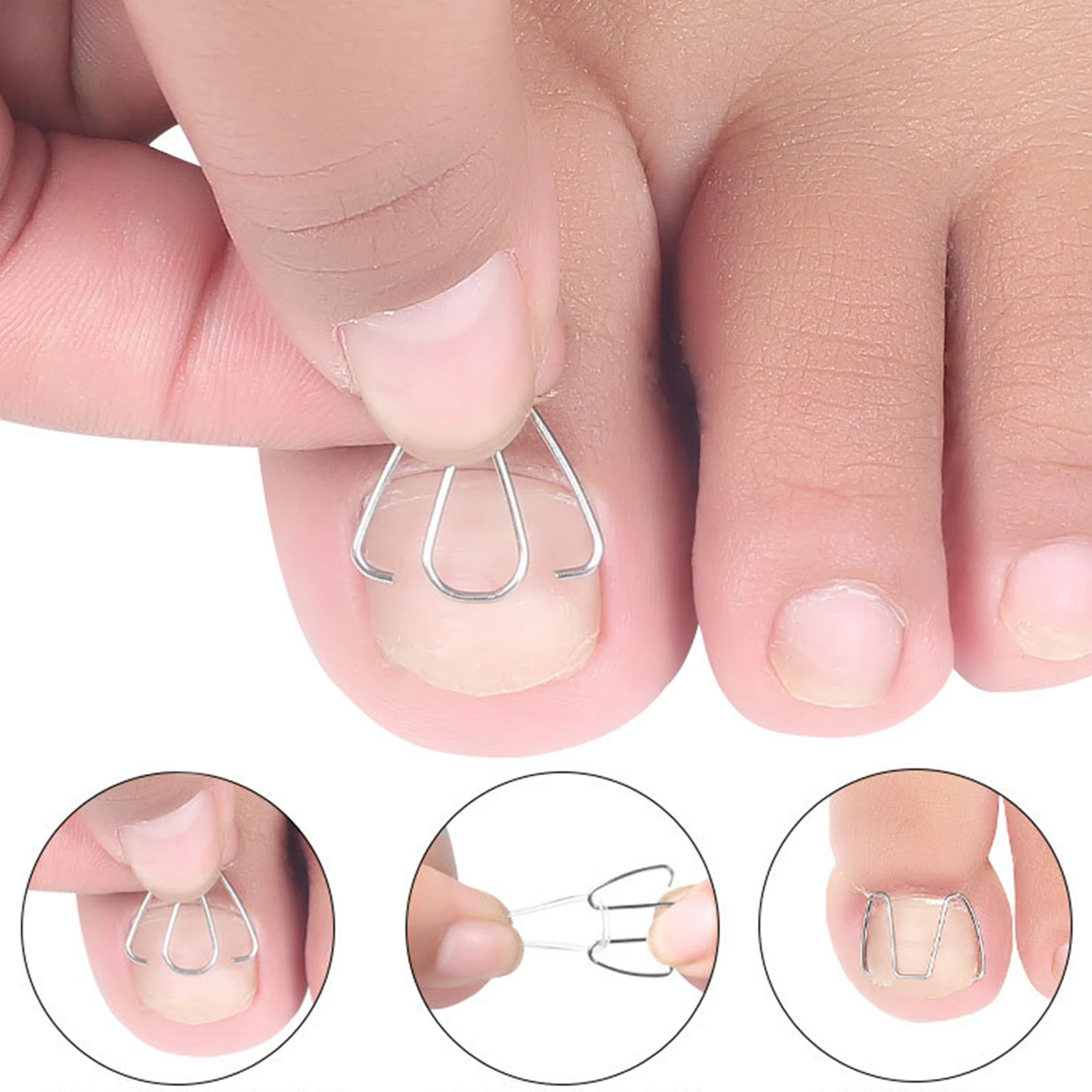 6x Ingrown Toe Nail Corrector Strips Wire Bunion Toenail Fixer Foot Care Recovery Nail Correction Hook For Relieve Discomfort