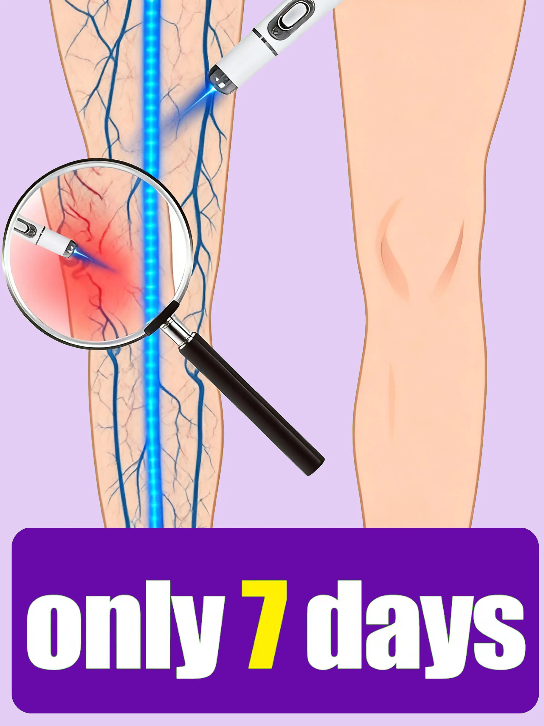 

2025 Unisx Generation Varicose Vein 3nd Laser Pointer Treatment Laser Eliminates Vasculitis Phlebitis Relieves Spider Leg Tool