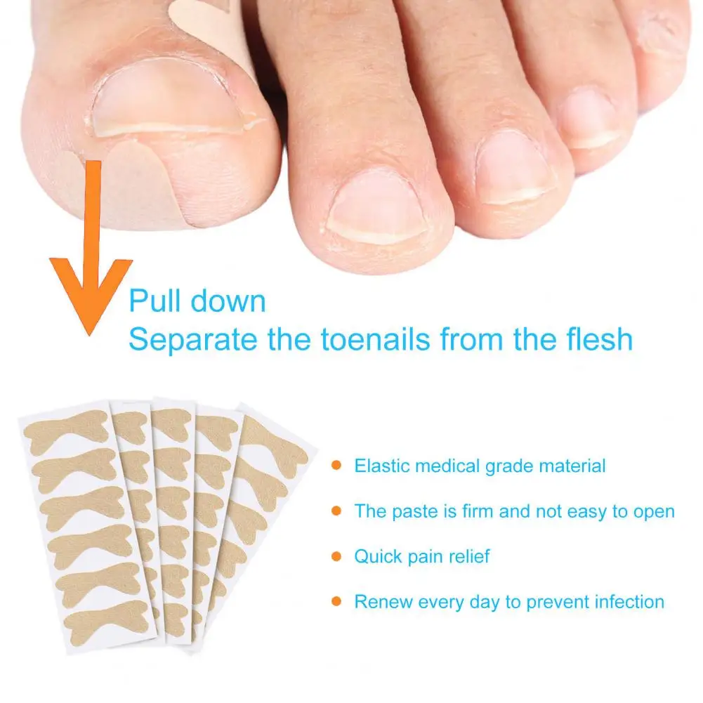 Nail Correction Stickers Skin-friendly Nail Patch 2pcs Toenail Corrector Stickers Breathable Nail Repair Patches for Home