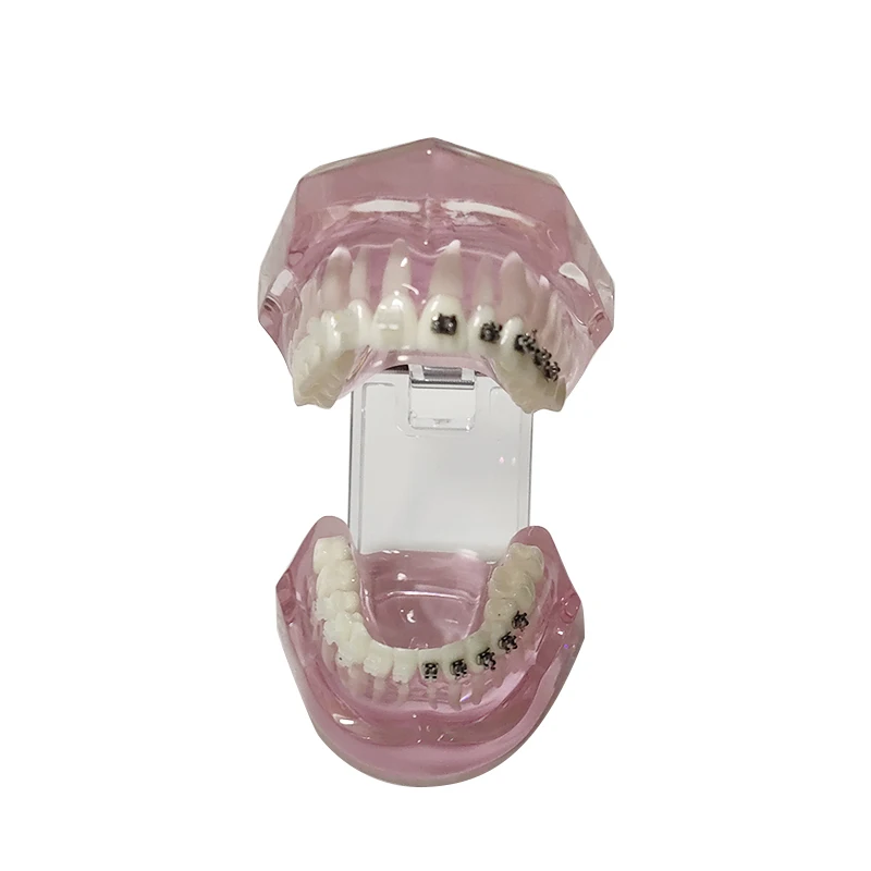 Clear Orthodontic Demonstration Model with Ceramic and Metal Brackets