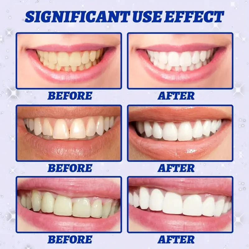 Tiras de Branqueamento dos Dentes para Dentes Falsos, Kit Dental, Folheados, Adesivo Decalque, Cuidados de Higiene Oral, Decalque, 9D, 5D Gel, 7