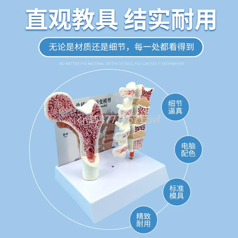 Human Femoral Osteoporosis Lesion Lumbar Anatomy Model Leg Bone Anatomy Spine Section Specimen