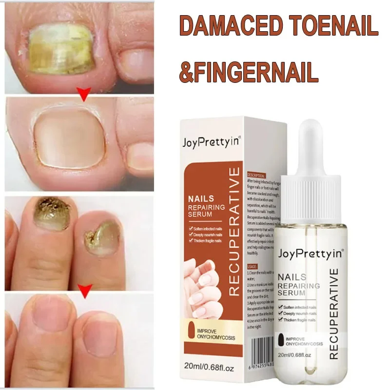 

Nail Fungus Treatment Essence Remove Onychomycosis Repair Damaged Nails Anti Toe Infection Gel Feet Cream Removal Nails Fungal