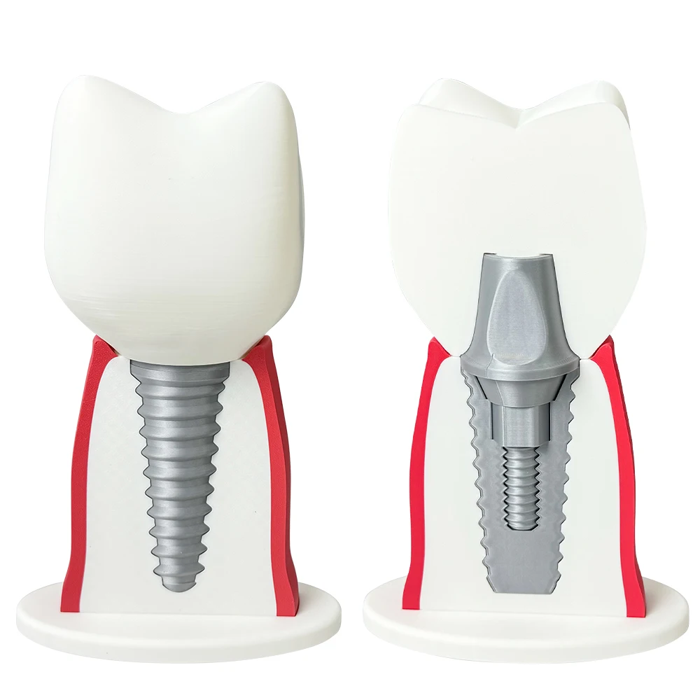 Over size Dental Implant Demonstration Model Large Detachable Tooth Implant Model for Dentist Patient Communication Study Tool