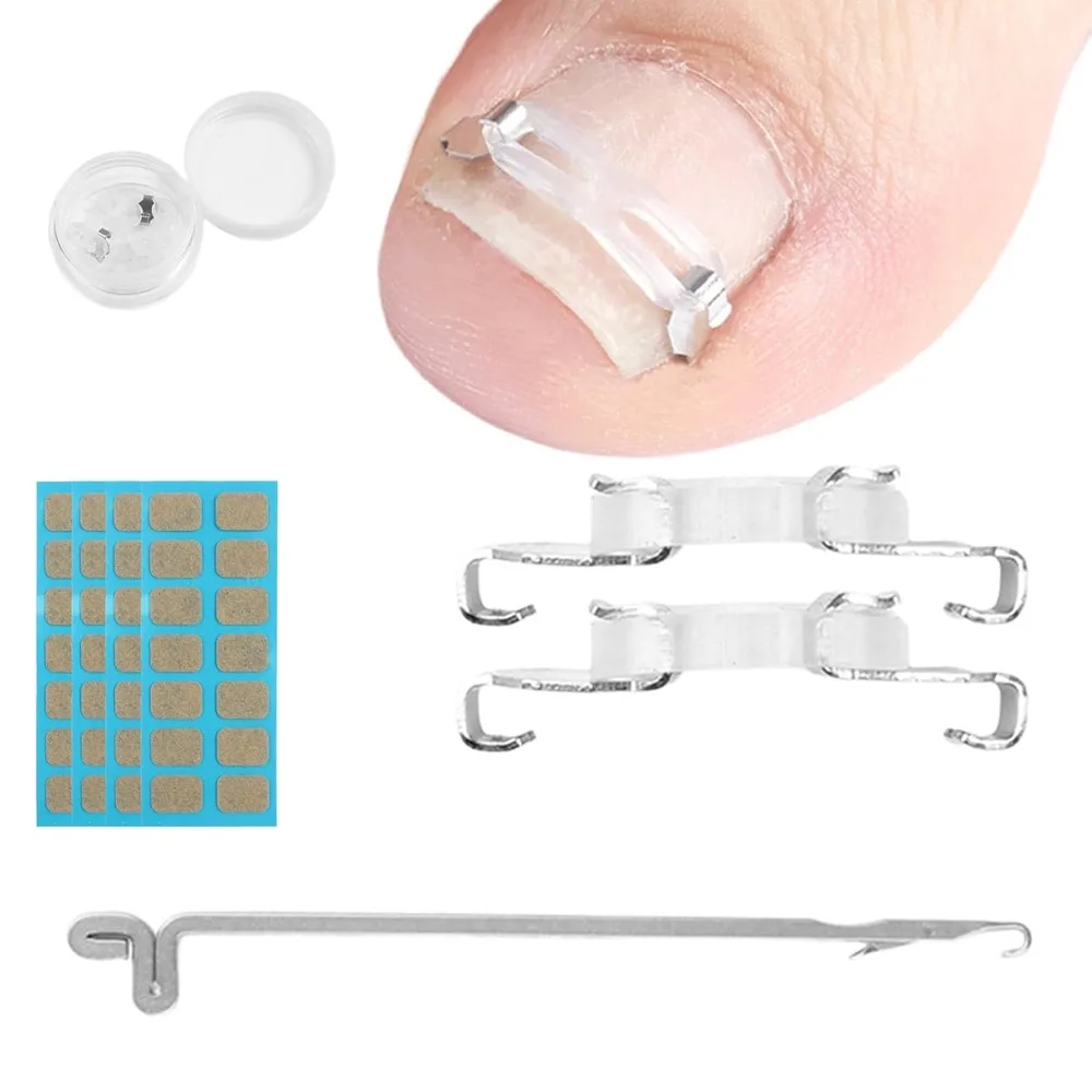 

Ingrown Toenail correction Kit, Professional Nail Care Tools with Correction Clips and Adhesive Pads