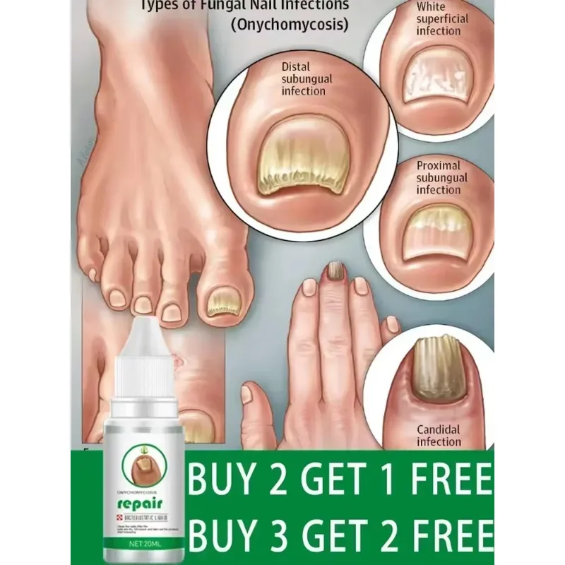 Beschermende huid Schimmel Nagel Behandeling Voetverzorging Essentie Nagel Voet Whitening Teen Nagel Schimmel Verwijdering Gel Anti Infectie Paronyc