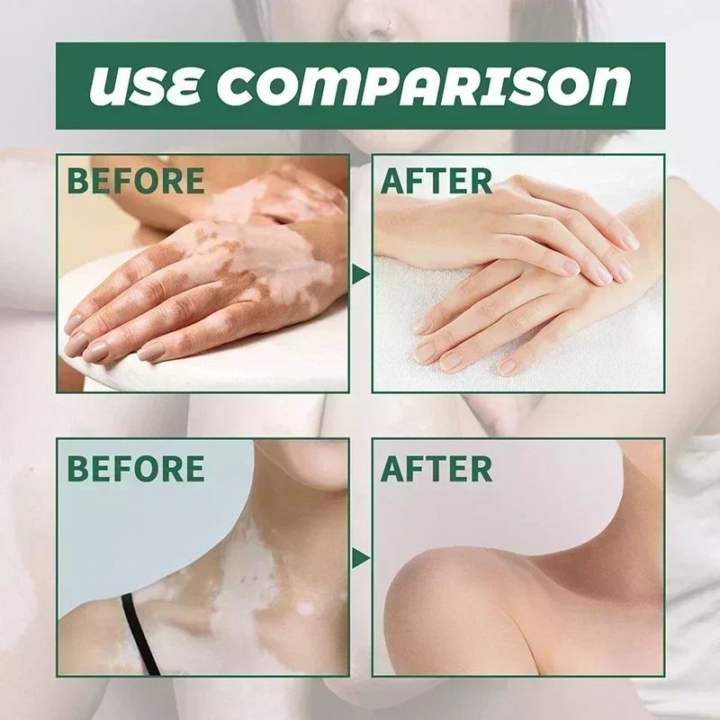 Vitiligo remover micose mancha branca gel remoção pele vitiligo eliminar vitiligo creme de cuidados com a pele externa