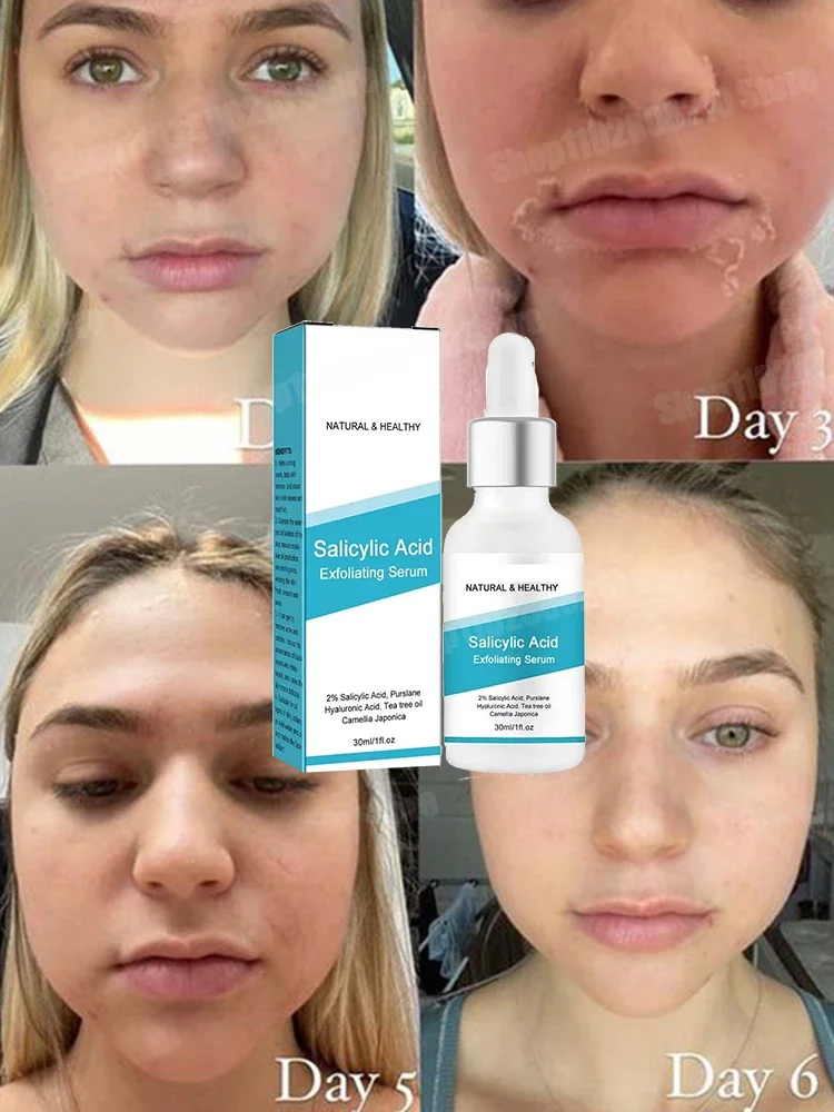 Salicylic Acid Face Facial Peel Neutraliser Face Deep At Home Chemical Peel Exfoliate Refine skin care serum