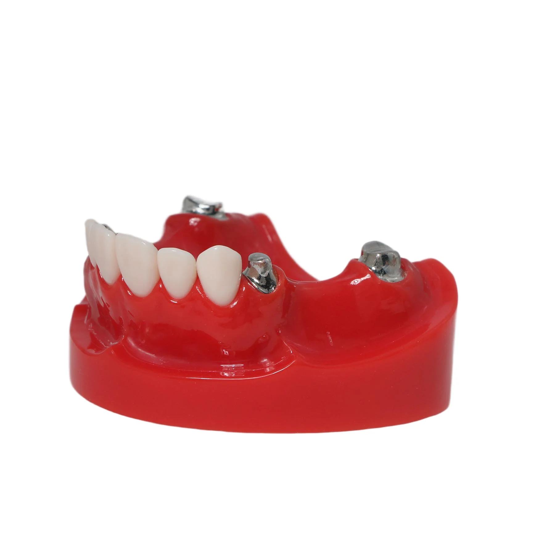 Dental Overdenture Typodont Teeth Model Telescope Crown Prosthetics Model with One Side Of The Gum Removable M6010