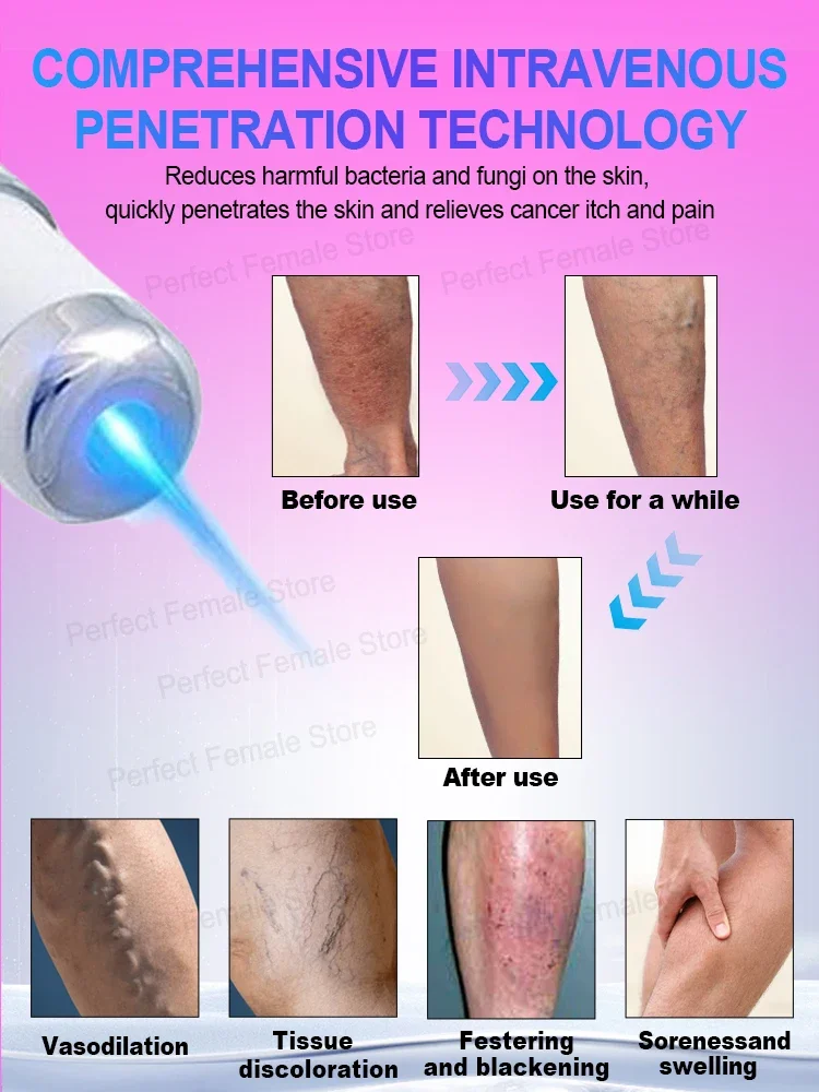 Varicose Veins Products