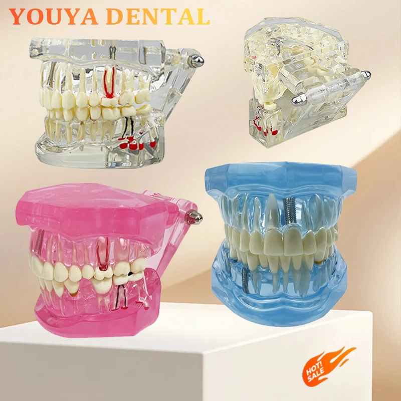 

1pcs Dental Model Implant Restoration Training Model Removable Tooth Model Dental Pathology Disease Demonstration