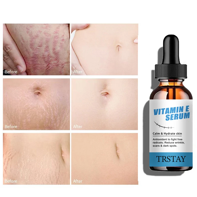 TRSTAY فيتامين E جوهر العناية بالبشرة مرطب التجاعيد الحد من الندبات والبقع يتلاشى للعناية بالحمل Striae Gravidarum #3