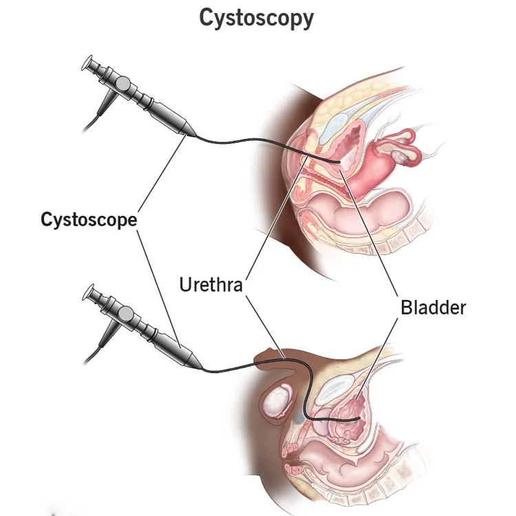 Best-selling Safe and Secure Portable Flexible Cystoscope for Medical Supplies Urological Endoscopy
