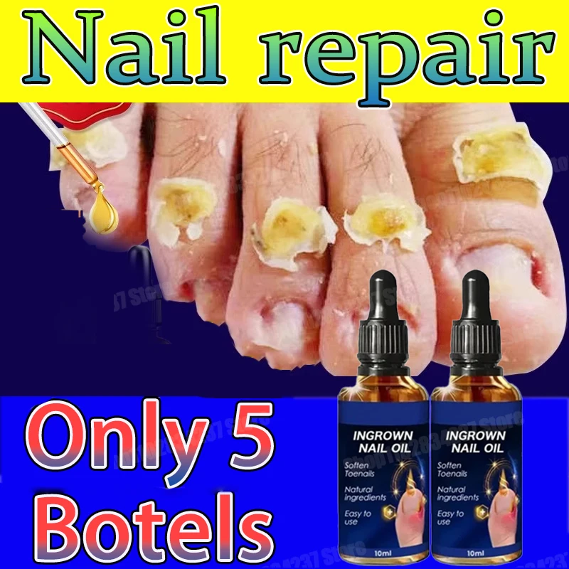 

Fungal Nail Removal 10ML Fungal Nail Treatment Oil Foot Repair Essence Toe Nail Fungus Removal Gel Anti Infection Cream