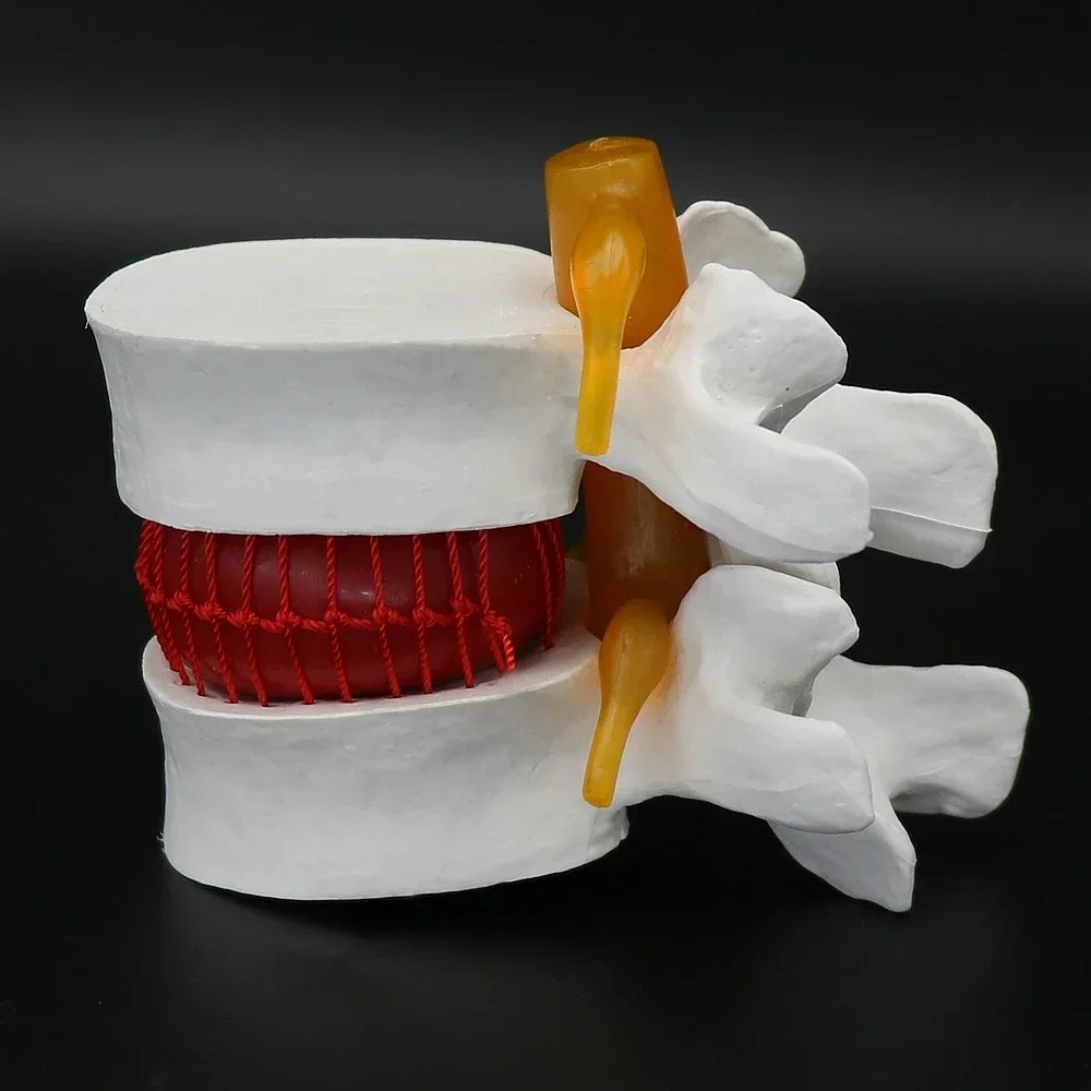 Human Anatomical Lumbar Disc Herniation Model Medical Learn Aid Anatomy Instrume Vertebrae Model