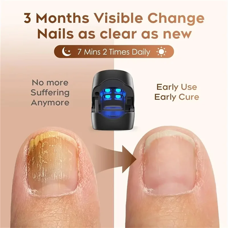 جهاز علاج فطريات الأظافر بالليزر 905 نانومتر وأزرق LED 470 نانومتر - فعال لعلاج فطار الأظافر في المنزل