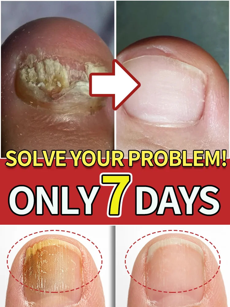 

Quick results Applicable to Toenails