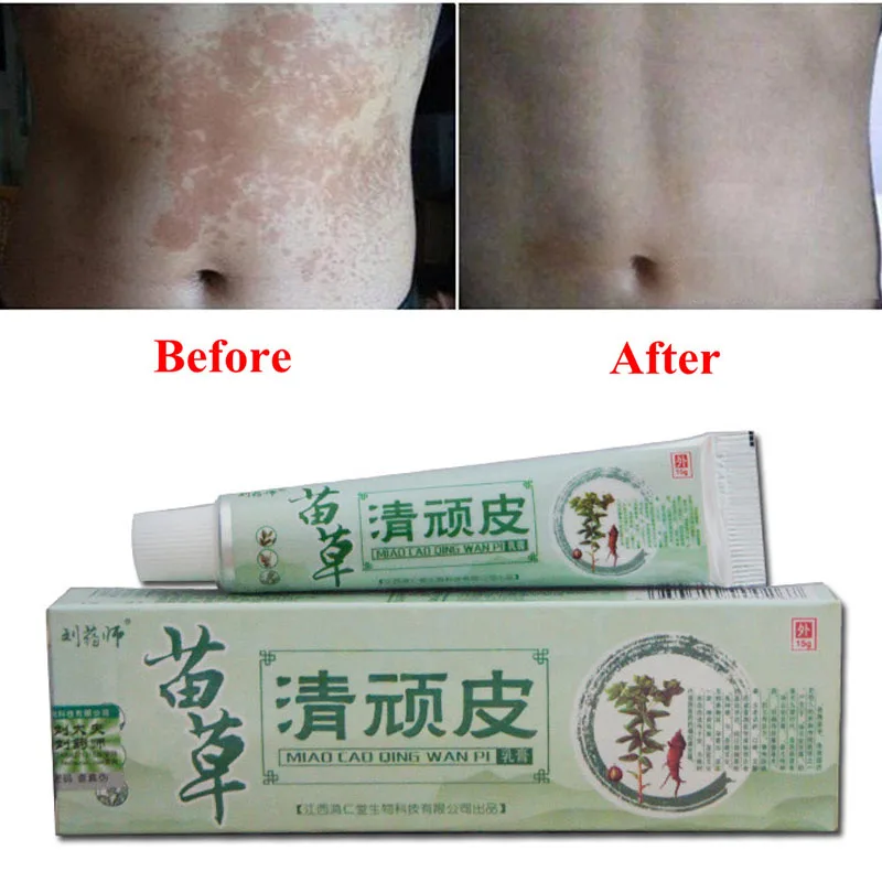 

Health psoriasis treatment cream Skin care Dermatitis Eczematoid Eczema Ointment eczema cream psoriasis Itching relief Ointment