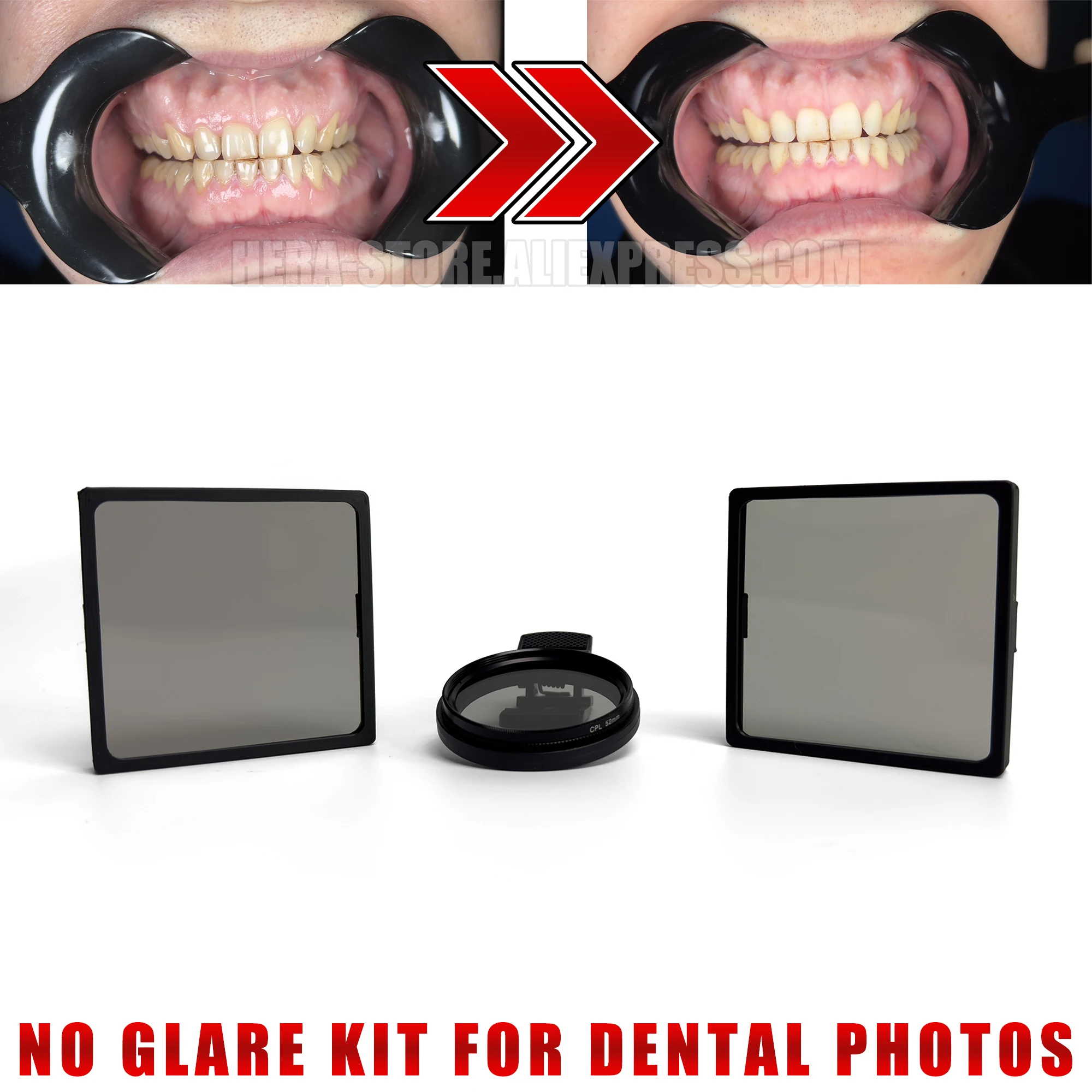 Dental Photography With No Reflection, No Glare. Cross Polarization Set For Intra Oral Photos and Video. Polarizers And CPL Lens