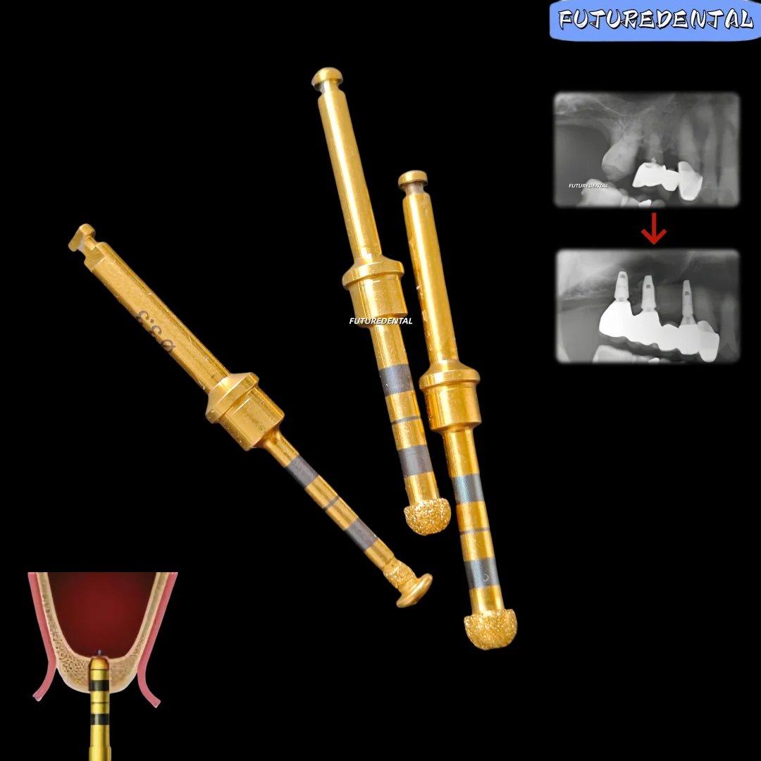 Kit de fraises diamantées à tête fine pour préparation dentaire, abord latéral de lifting du sinus maxillaire, pour implantation d'implants, finition dorée