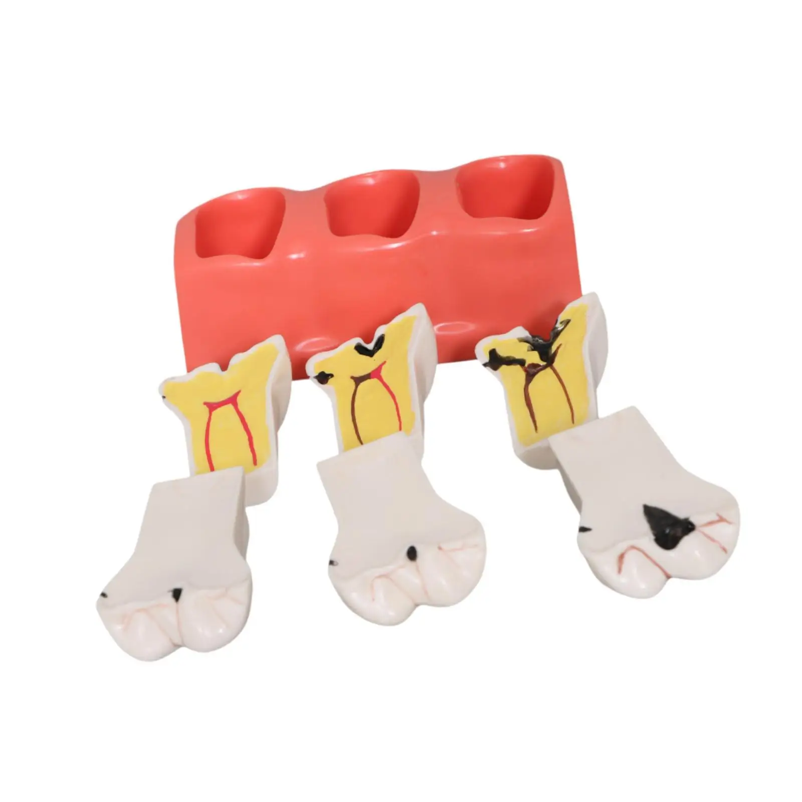Decayed Tooth Model with Three Stage Decay Educational Toy for Student Demonstration