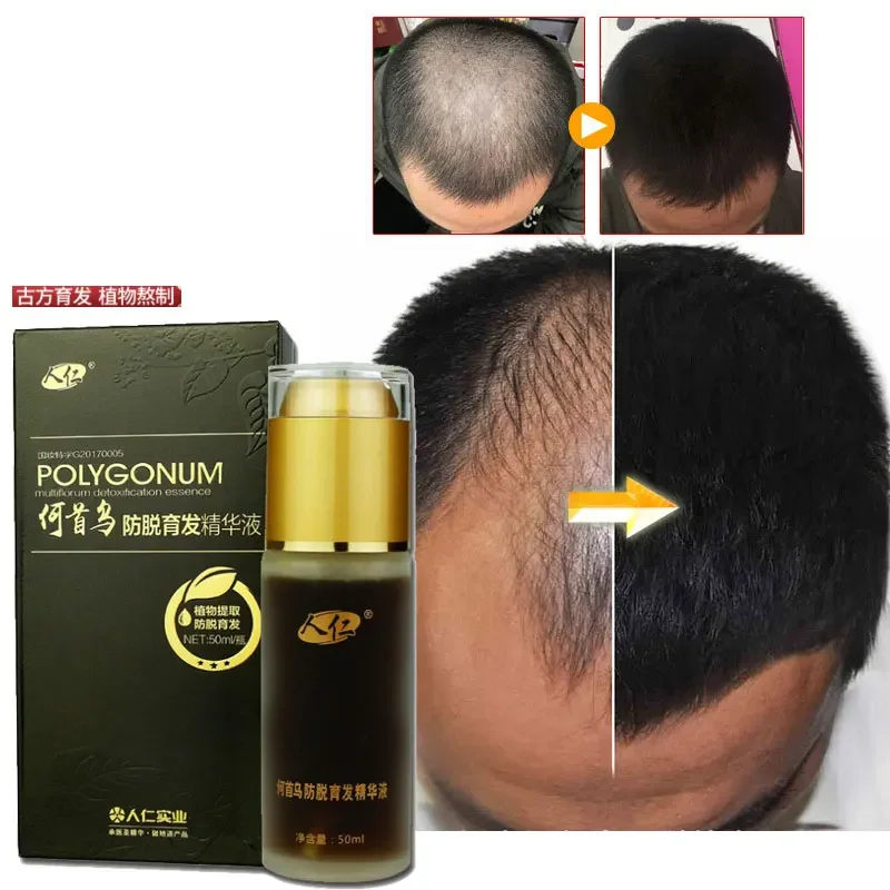 Producto Natural rizado para el crecimiento del cabello para hombres, champú anticaída, alisado eficiente del cabello, aceites esenciales a base de hierbas, 50ml