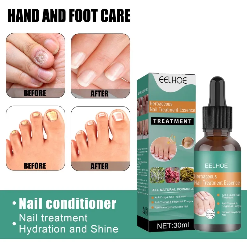 Onychomycosis Repair Solution Hand and Foot Soft Nail Thickening Brightening Nail Anti-Fungal Polish Bump Nail Care Solution