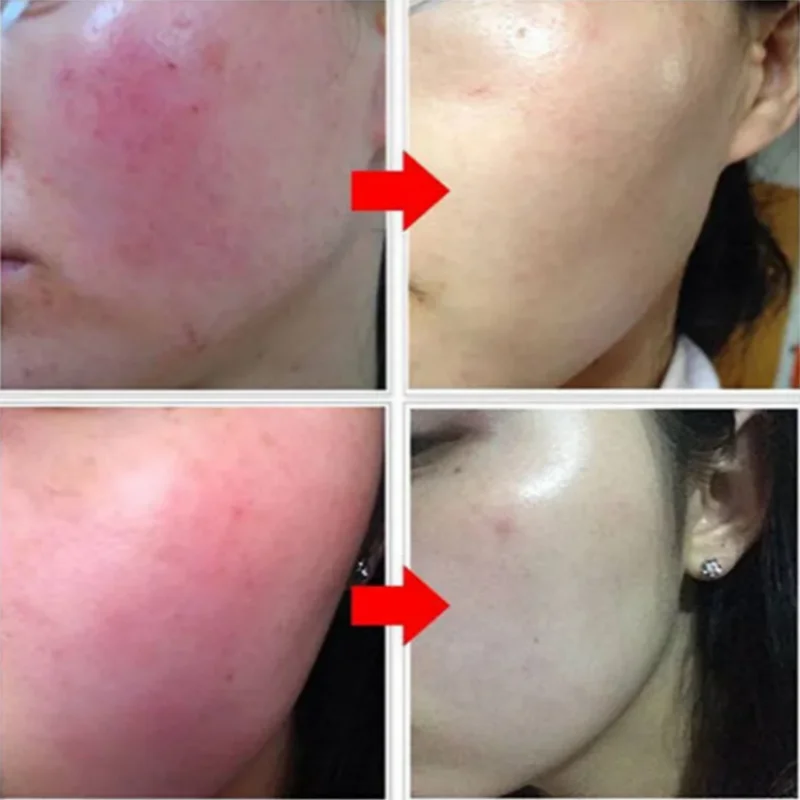 Facial Redness Repair Serum Against Redness Rosacea Spider Vein Treatment Sensitive Skin Shrink Pore Korean Face Skin Care Cream