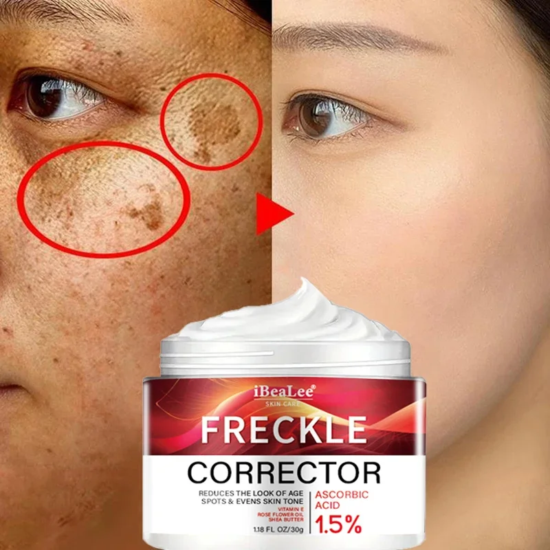 

Freckle Whitening Cream Black Dots Melasma Remover Anti Brown Stain Lighten Pigmentation Moisturizing Skin Care Korean Products