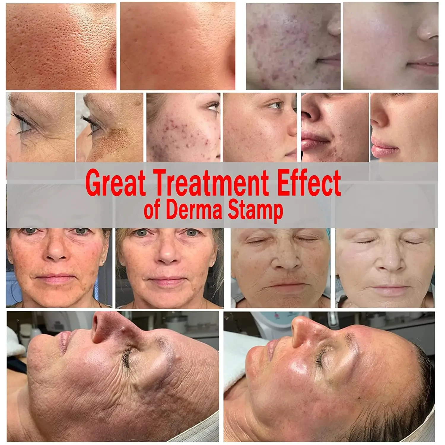 Derma Stamp 120 Pin Needles Microneedle Bio Needle for Hair Regrowth Face Skin Care Derma Roller Beauty Device Kalem