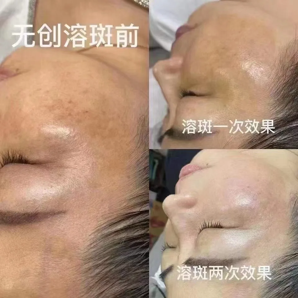 Plaque dissolving liquid chloasma removing dermal freckles 377 freckle removing liquid whitening freckle removing essence