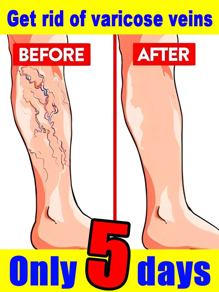 

Инструменты для ухода за ногами Уменьшите неудобно для ног, улучшающие кровообращение, ручка для варикозного расширения вен, средство для ухода за кожей