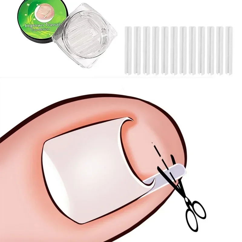 Ultradunne Ingegroeide Teennagel Corrector Gereedschap C-vormige Buis Pad Corrigeren Nagels Groei Paronychia Behandeling Herstellen Pedicure Gereedschap