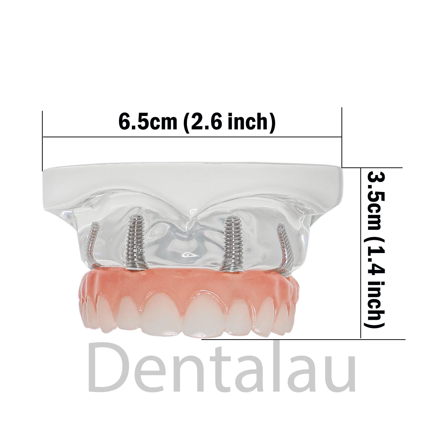 Dental Teeth Model Simulation Transparent Upper Jaw 4 Overdenture Modle With 4 Removable Screws Dentist Teaching Studying Demo