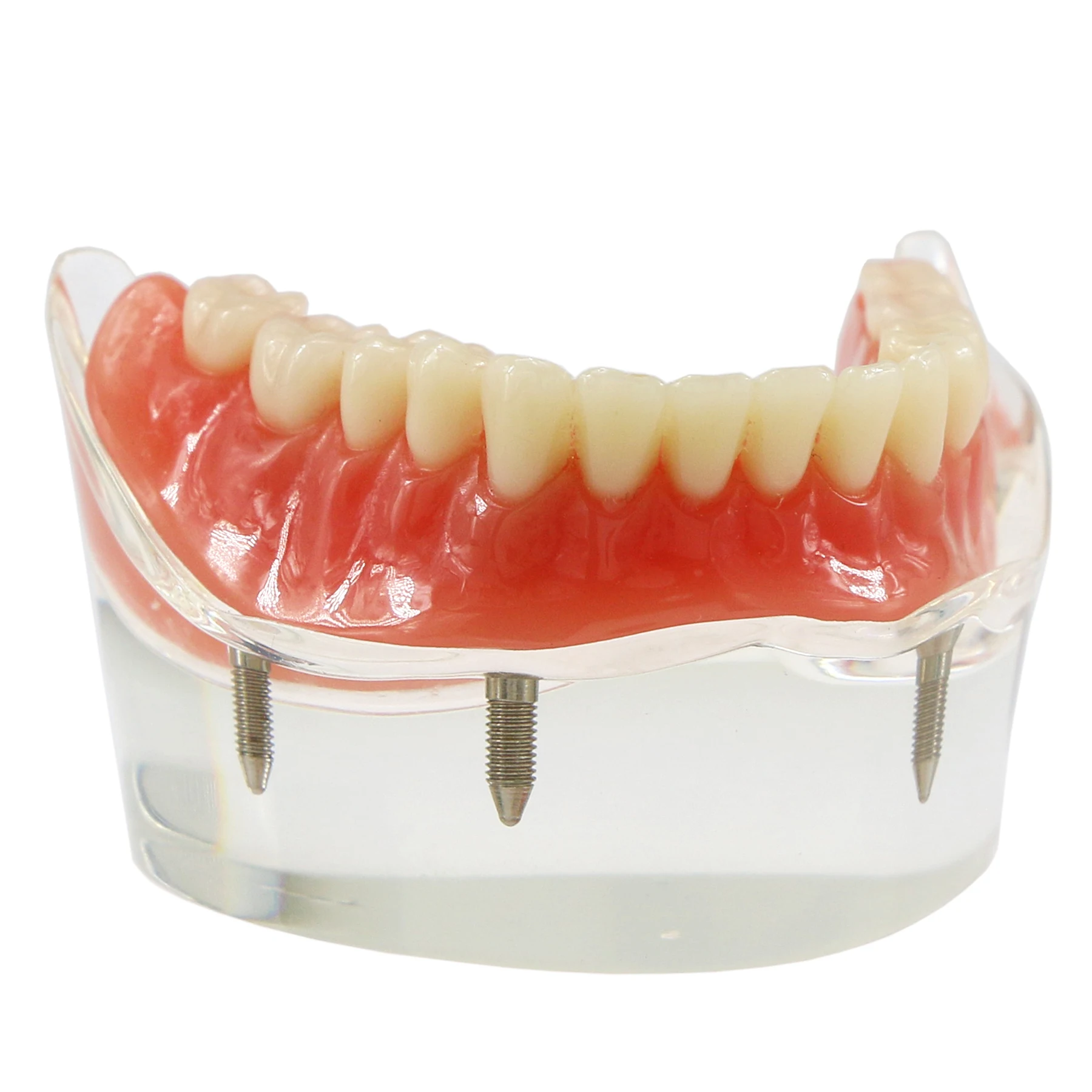 

Dental Teeth Model Overdenture Inferior with 4 Implants Restoration Mode M6003