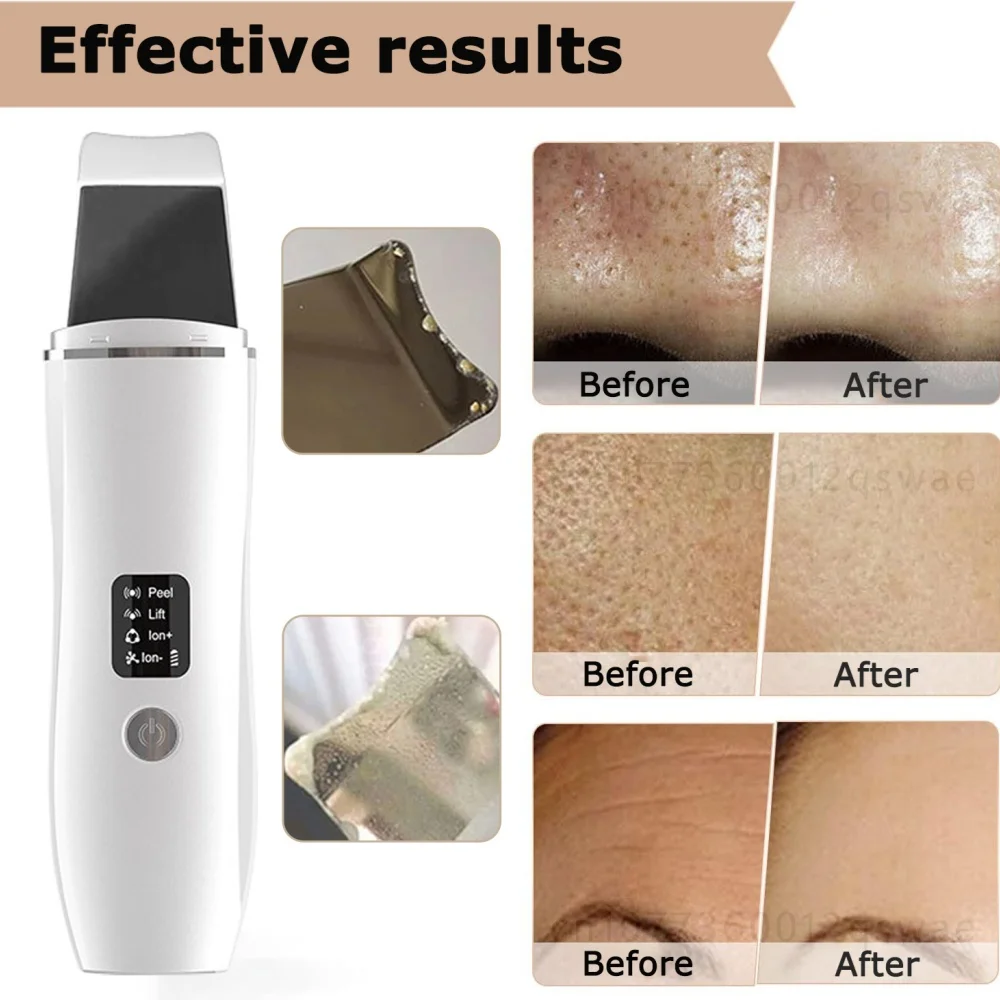 Ultrasonic profunda limpeza cravo removedor, Pele Facial Scrubber, Cavitação Peeling Pá