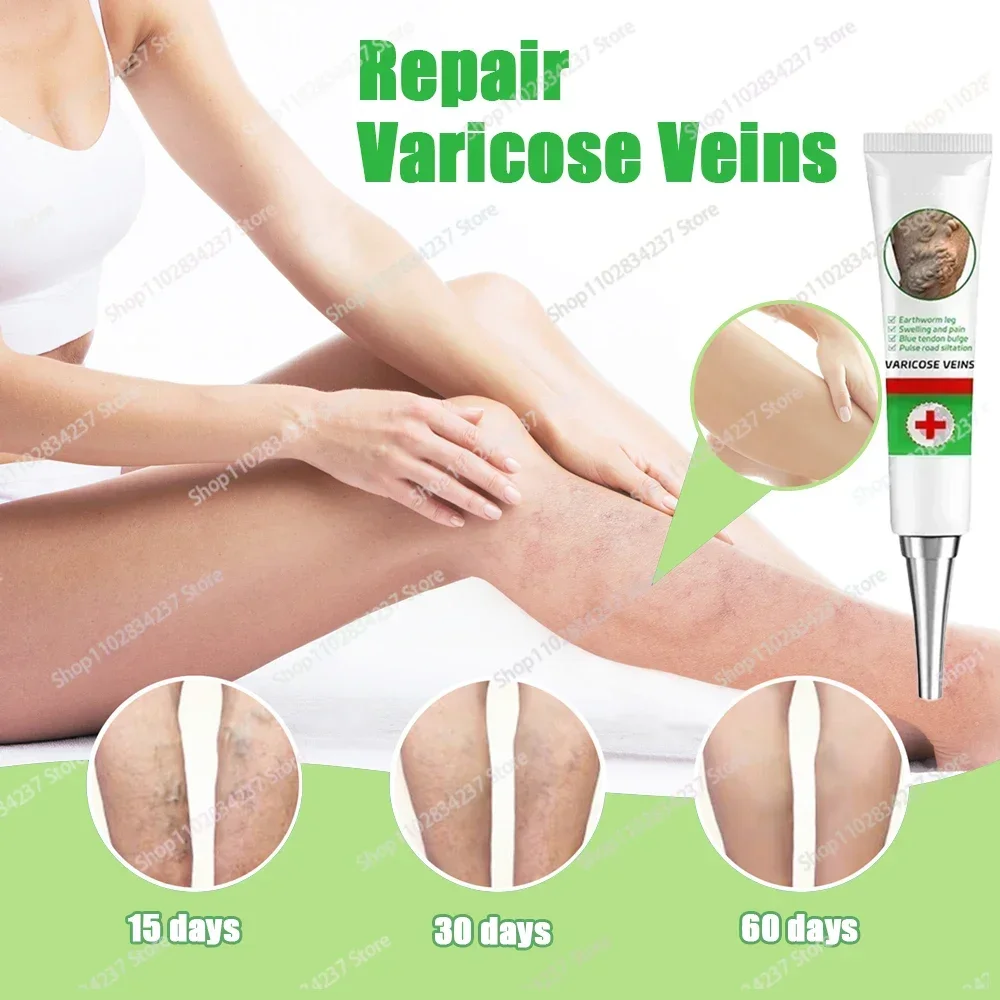 

Effective Varicose Vein Relief Eliminate Vasculitis Phlebitis Spider Legs Soothing Skin