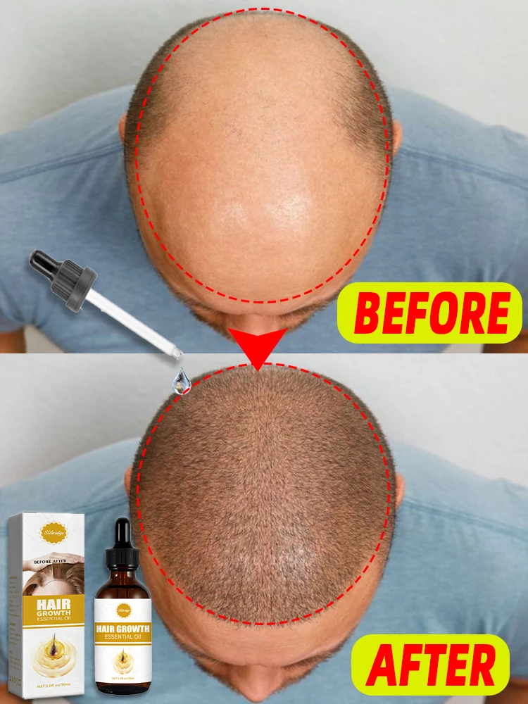 

Rapid Growth Hair Oil Effective Repair Baldness Hair Follicles Hereditary Hair Loss Postpartum Hair Loss Seborrheic Hair Care