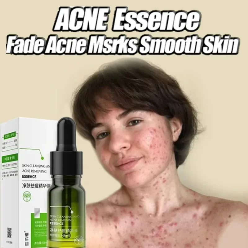 

Acne Removal serum Acne-removing oil Improve Acne Pimple Moisturizer face Repair oil Control Skin Care Products