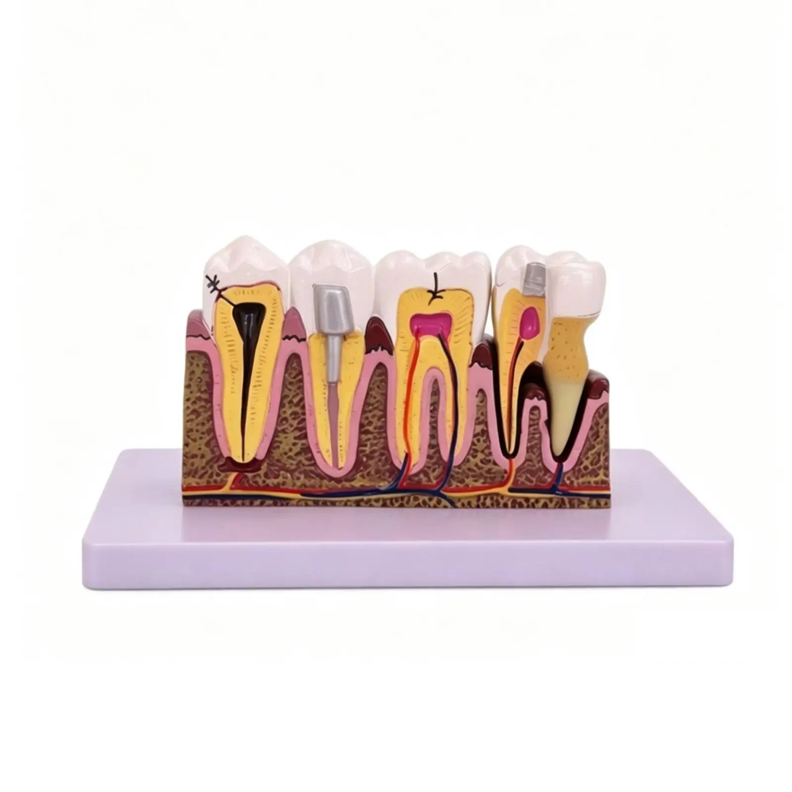 Dental Pathology Display Model Enlarged Cross Section Tooth Anatomy with Caries Root Canal Pulp for Education