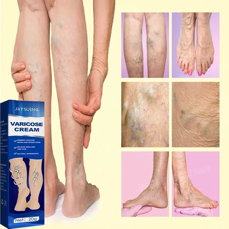 Vein repair cream reduces varicose veins, promotes blood circulation and vasoconstriction essence of leg care