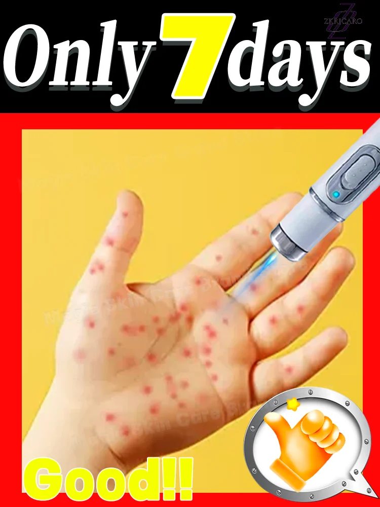 

Lᴀsᴇʀ Wᴀʀᴛs Rᴇᴍᴏᴠᴀʟ Blue Light Wart Removal Tool