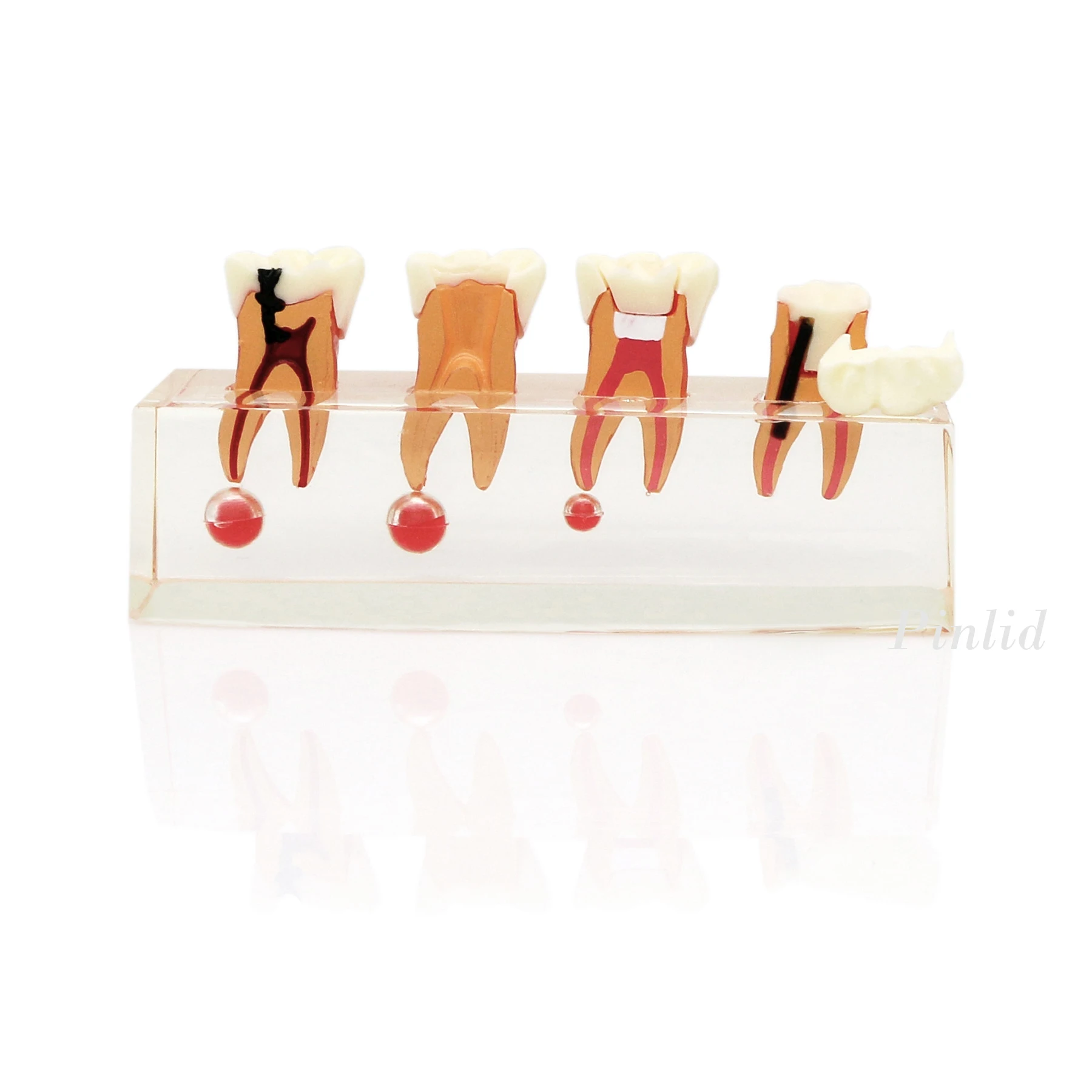 Dental Treatment Model 4-Stage Endodontic  for Study Teaching Teeth Model 4018 Root Canal Demonstration Teach Tooth Model Clear